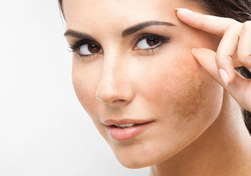 Peeling Melasma TRX
