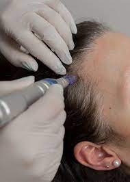 Mesoterapia Capilar Dermapen