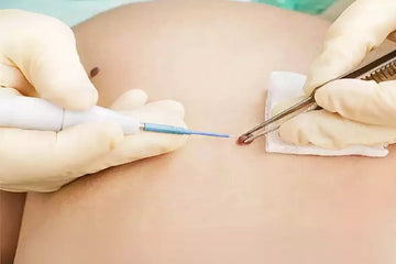 Resección Electrofulguración Queratosis