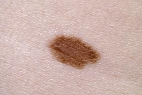 Resección Nevus