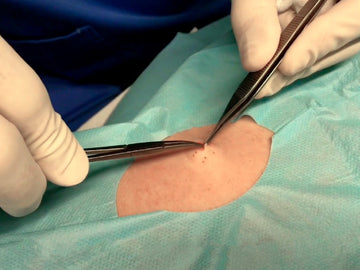 Resección Tumor Benigno