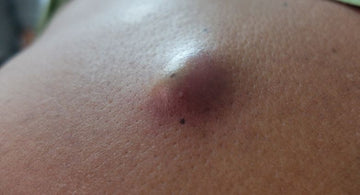 Resección Masa de Sebo