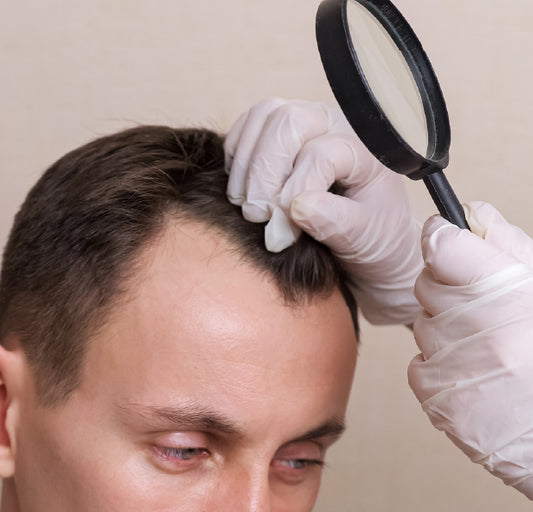 Tratamiento para la caída del cabello y alopecia en Popayán