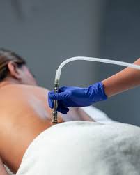 microdermoabrasión Espalda x Sesión