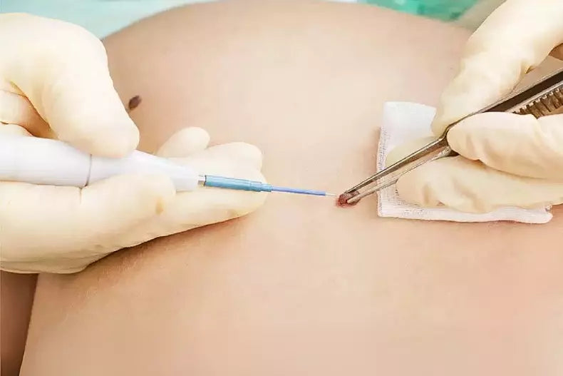 Resección Electrofulguración Queratosis